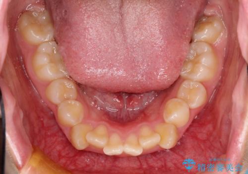 抜歯矯正で口元に変化を ラビアル・ワイヤー矯正でEラインの治療前