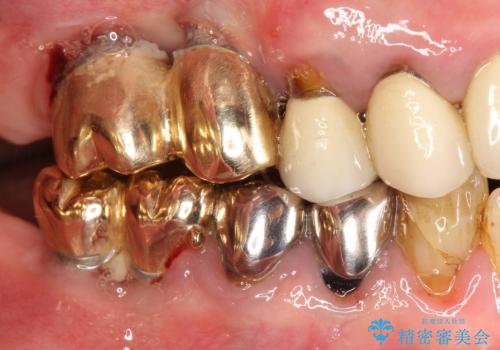 薄い骨にもインプラントを スプリットクレスト+ショートインプラントの応用の治療前