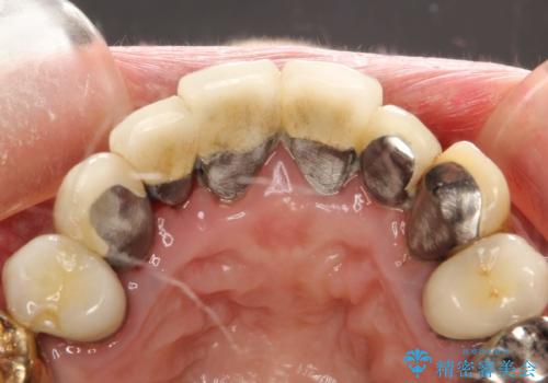 前歯の低クオリティな治療の実態 妥協無い治療で根本からやり治すの治療前