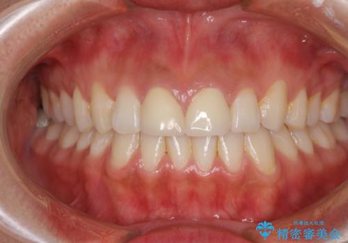 前歯の隙間をオールセラミックで閉じるの治療後