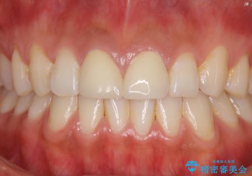 前歯の隙間をオールセラミックで閉じるの治療後