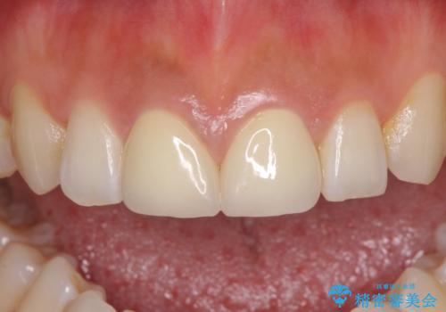 前歯の隙間をオールセラミックで閉じるの症例 治療後
