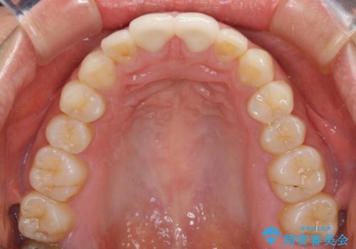 前歯の隙間をオールセラミックで閉じるの治療後