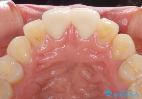 前歯の隙間をオールセラミックで閉じるの治療後