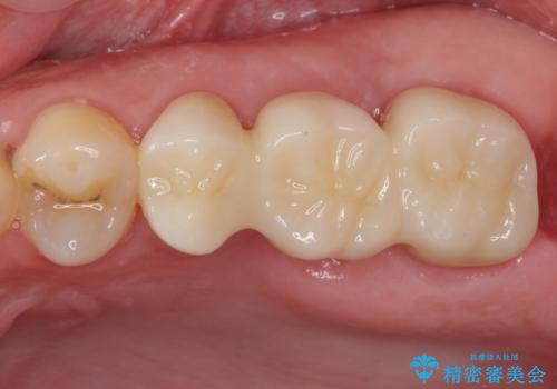 長い間虫歯を放置　奥歯のブリッジ治療の治療後