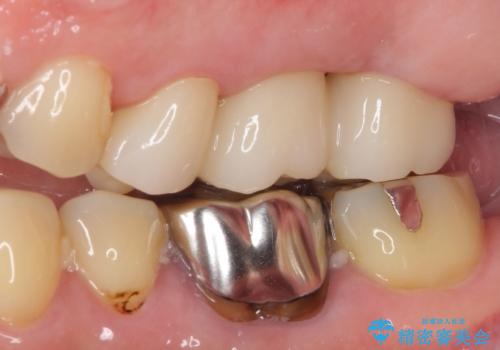 長い間虫歯を放置 奥歯のブリッジ治療の治療後