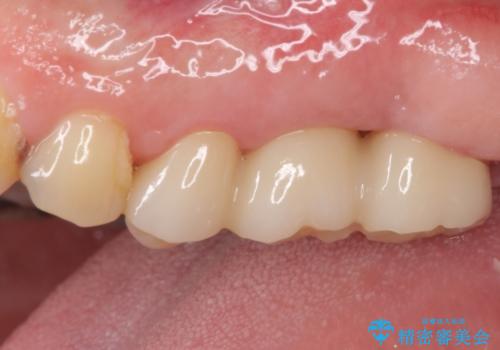 長い間虫歯を放置 奥歯のブリッジ治療の治療後