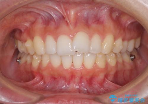 口が閉じにくい 1本飛び出した前歯の矯正治療の治療中