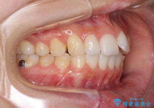 口が閉じにくい 1本飛び出した前歯の矯正治療の治療中