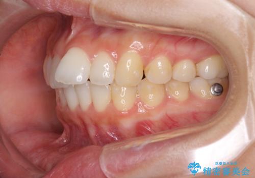 口が閉じにくい 1本飛び出した前歯の矯正治療の治療中