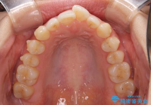 口が閉じにくい 1本飛び出した前歯の矯正治療の治療中