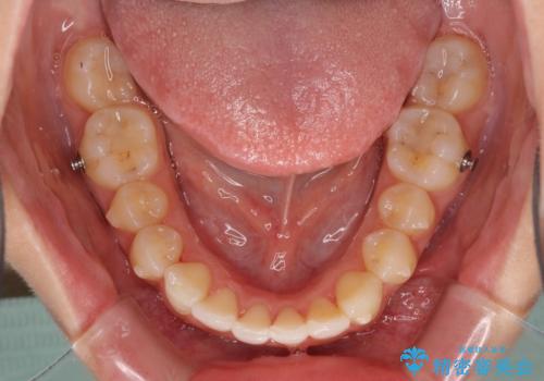 口が閉じにくい 1本飛び出した前歯の矯正治療の治療中