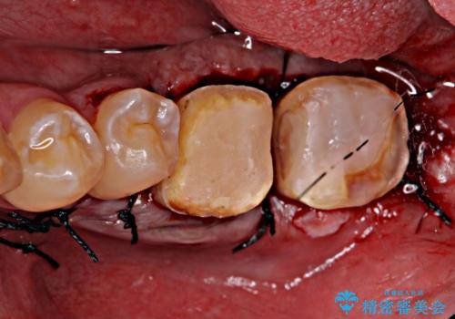 歯冠長延長術を併用した審美的歯科治療の治療後