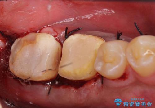歯冠長延長術を併用した審美的歯科治療の治療後