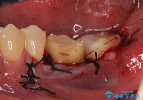 歯冠長延長術を併用した審美的歯科治療の治療後