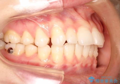 インビザラインで出っ歯を改善する　抜歯をしないinvisalign治療の治療中