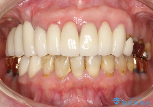 前歯の低クオリティな治療の実態　妥協無い治療で根本からやり治すの治療後