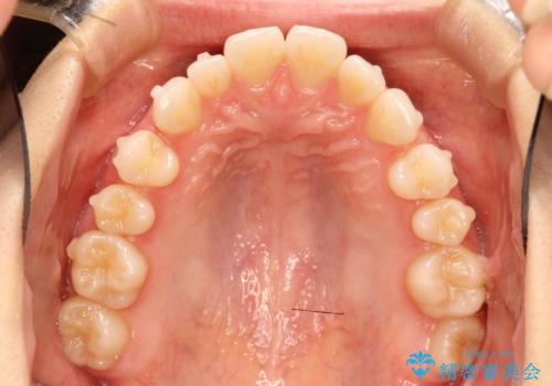 インビザラインで出っ歯を改善する　抜歯をしないinvisalign治療の治療中