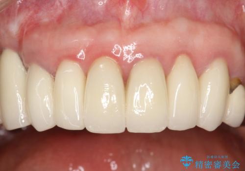 前歯の低クオリティな治療の実態 妥協無い治療で根本からやり治すの治療後
