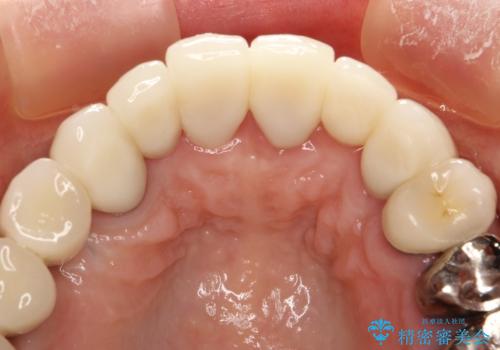 前歯の低クオリティな治療の実態 妥協無い治療で根本からやり治すの治療後