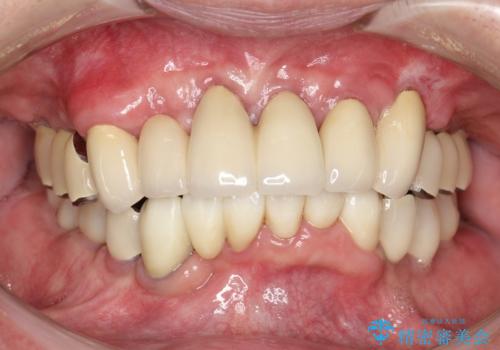 虫歯だらけ、歯周病　崩壊した口腔の再建　フルマウスリコンストラクションの症例 治療後