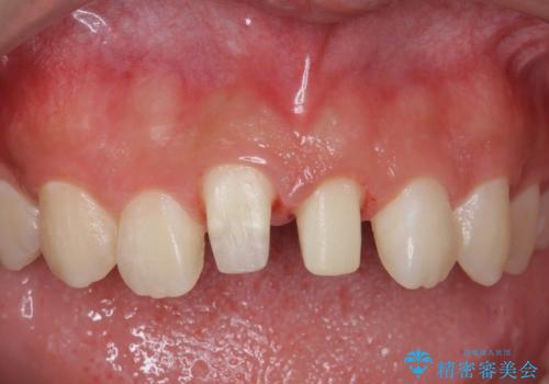 出っ歯をセラミックで治したい の治療中