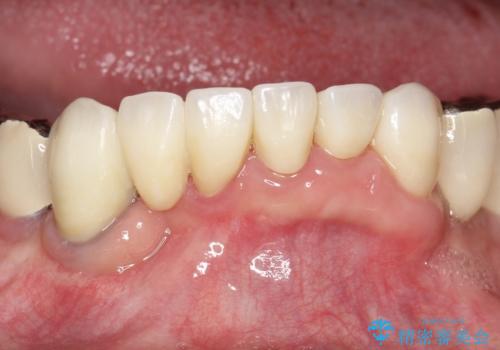 虫歯だらけ、歯周病 崩壊した口腔の再建 フルマウスリコンストラクションの治療後