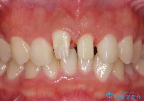 出っ歯をセラミックで治したい の治療中