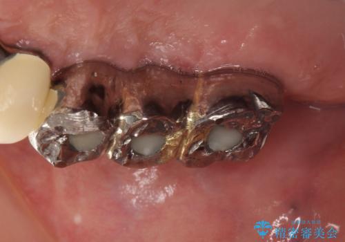虫歯だらけ、歯周病 崩壊した口腔の再建 フルマウスリコンストラクションの治療後