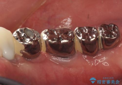 虫歯だらけ、歯周病　崩壊した口腔の再建　フルマウスリコンストラクションの治療後