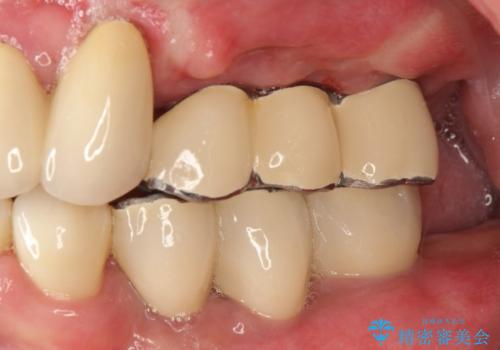虫歯だらけ、歯周病 崩壊した口腔の再建 フルマウスリコンストラクションの治療後