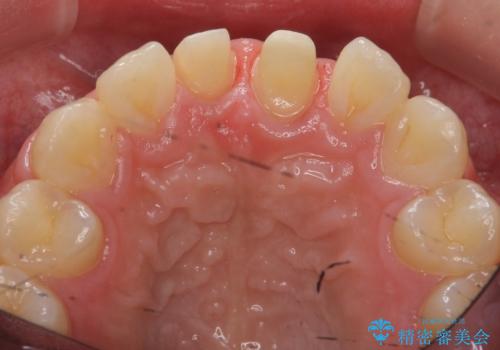 出っ歯をセラミックで治したい の治療中