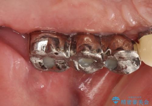虫歯だらけ、歯周病 崩壊した口腔の再建 フルマウスリコンストラクションの治療後