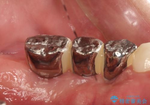 虫歯だらけ、歯周病 崩壊した口腔の再建 フルマウスリコンストラクションの治療後