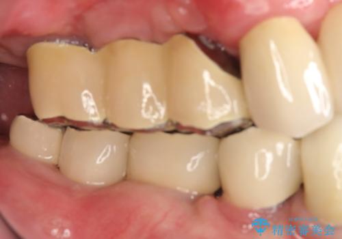 虫歯だらけ、歯周病 崩壊した口腔の再建 フルマウスリコンストラクションの治療後