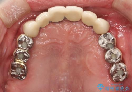 虫歯だらけ、歯周病 崩壊した口腔の再建 フルマウスリコンストラクションの治療後