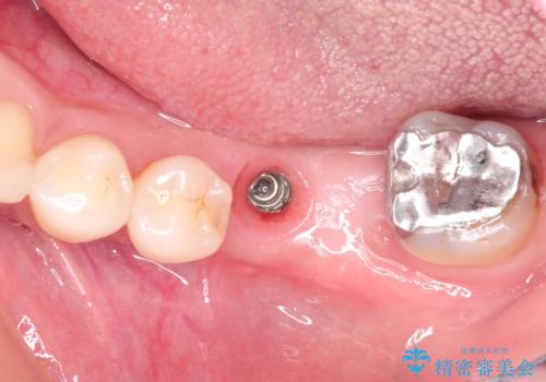 見えない歯周病 長期予後を見据えてインプラントにの治療後