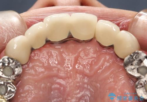 虫歯だらけ、歯周病 崩壊した口腔の再建 フルマウスリコンストラクションの治療後