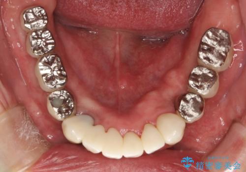 虫歯だらけ、歯周病 崩壊した口腔の再建 フルマウスリコンストラクションの治療後