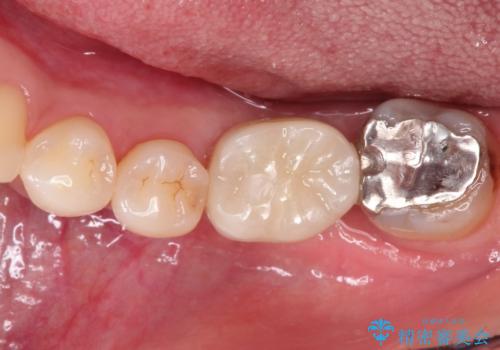 見えない歯周病 長期予後を見据えてインプラントにの治療後