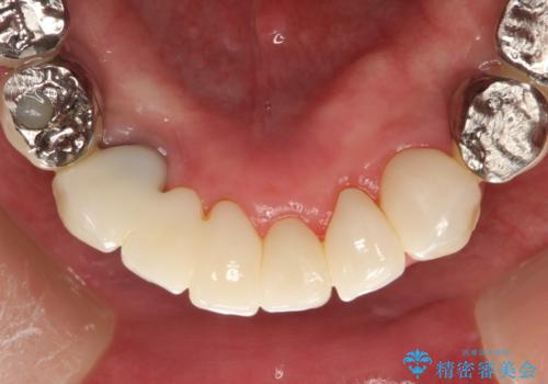 虫歯だらけ、歯周病　崩壊した口腔の再建　フルマウスリコンストラクションの治療後