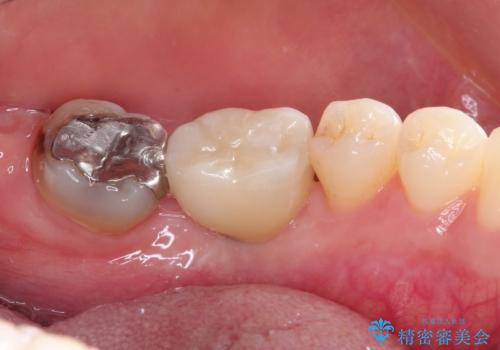 見えない歯周病 長期予後を見据えてインプラントにの治療後