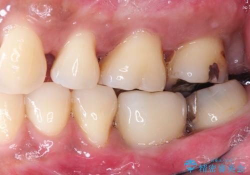 見えない歯周病　長期予後を見据えてインプラントにの症例 治療後