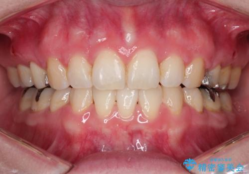 口が閉じずらく、口元出てるのが気になる　ワイヤー抜歯矯正による口元の改善の症例 治療後