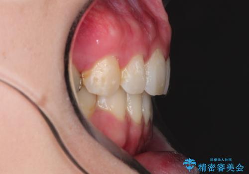 口が閉じずらく、口元出てるのが気になる　ワイヤー抜歯矯正による口元の改善の治療後