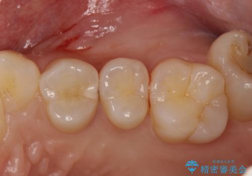 気づかないうちに大きな虫歯が 神経を保存し、セラミックで修復の症例 治療前