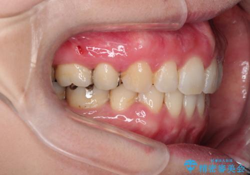 口が閉じずらく、口元出てるのが気になる　ワイヤー抜歯矯正による口元の改善の治療後