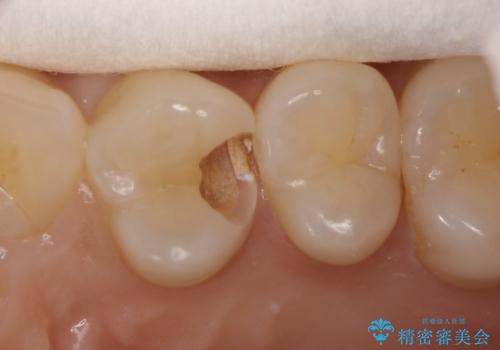 気づかないうちに大きな虫歯が 神経を保存し、セラミックで修復の治療中