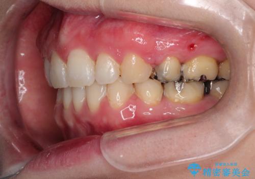 口が閉じずらく、口元出てるのが気になる ワイヤー抜歯矯正による口元の改善の治療後