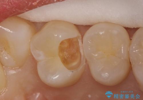 気づかないうちに大きな虫歯が 神経を保存し、セラミックで修復